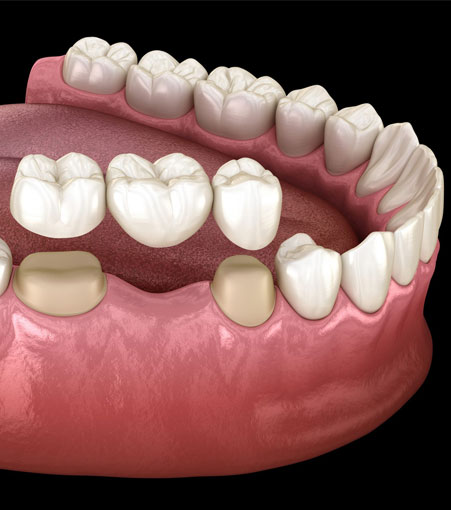 Dental Bridge Restoration