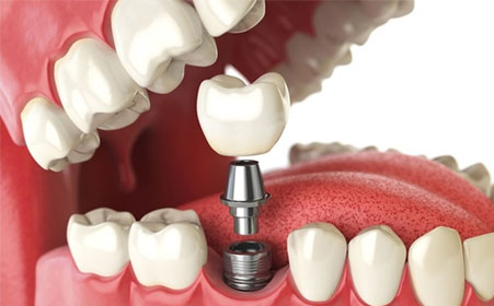 Dental Implant