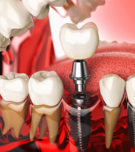 Dental Implant