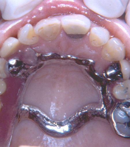 Maxillofacial Prosthesis