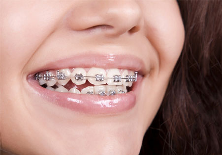 Orthodontic Treatment