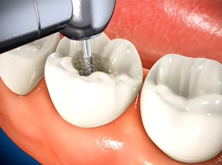 Root Canal Treatment