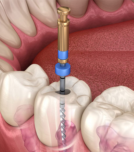 Painless Root Canal Treatment