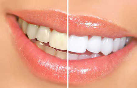 Teeth Whitening