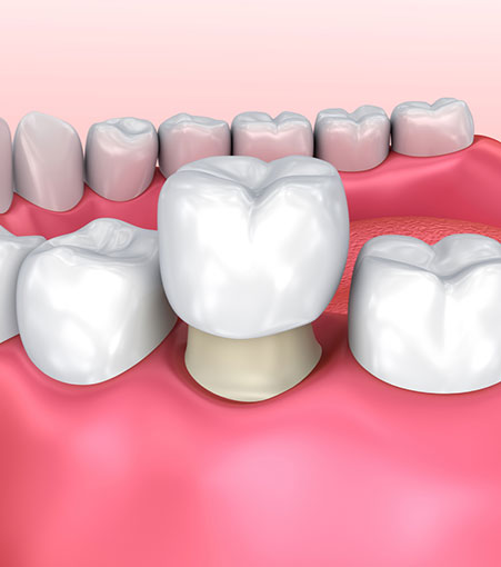 Dental Crown Fixing