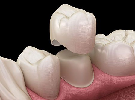 Dental Crown Treatment