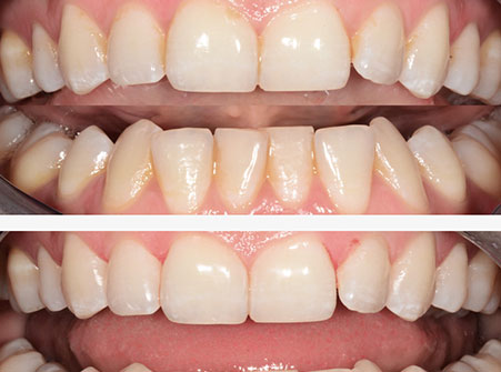 Teeth Whitening