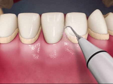 Ultrasonic Scaling