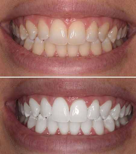 Teeth Whitening Treatment