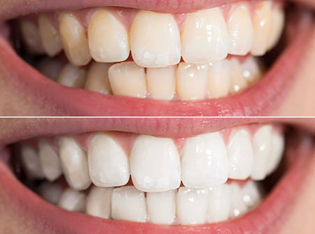 Teeth Whitening