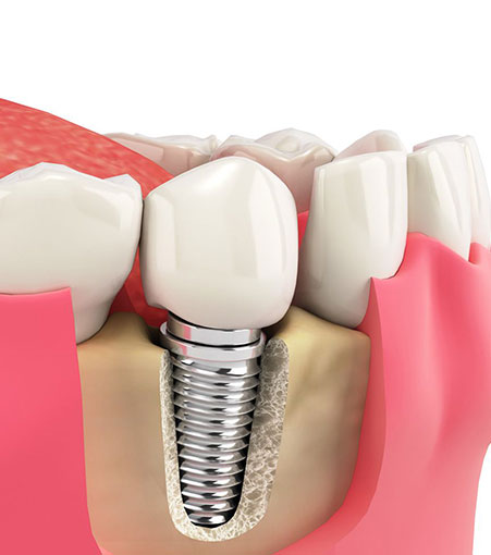 Dental Implant Care