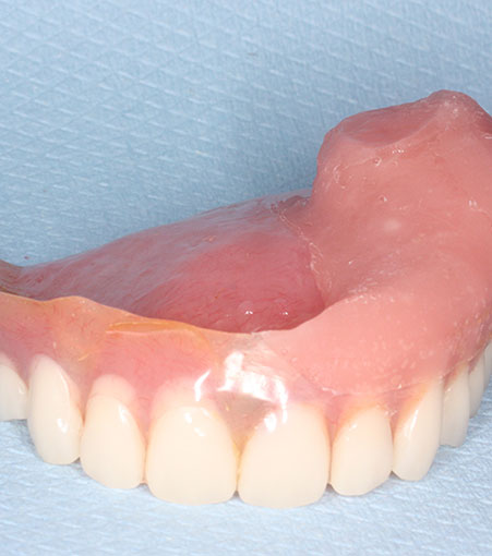 Maxillofacial Prosthetics Treatment