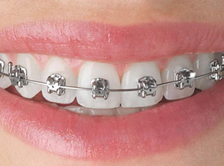 Orthodontic Treatment