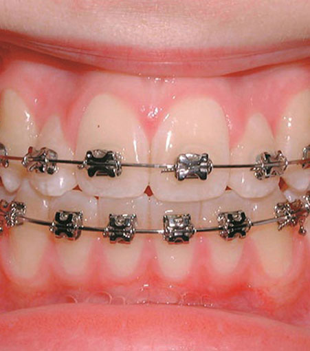 Orthodontic Treatment Care