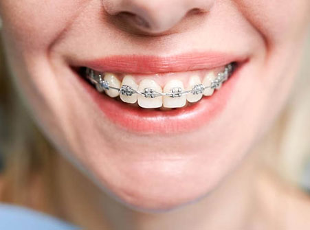 Orthodontic Care