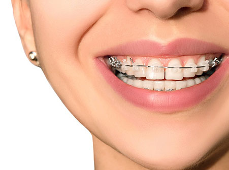 Orthodontic Treatment