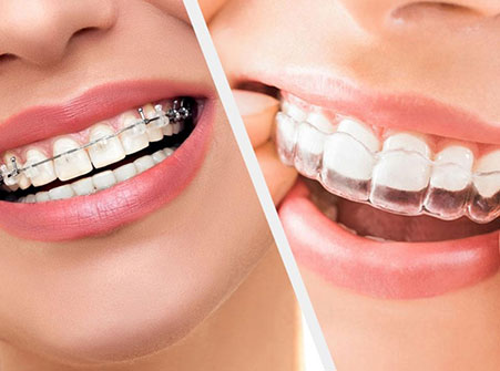 Orthodontic Treatment