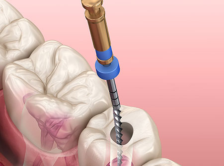 Root Canal Treatment