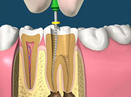 Root Canal Treatment