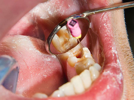 Painless Root Canal Treatment