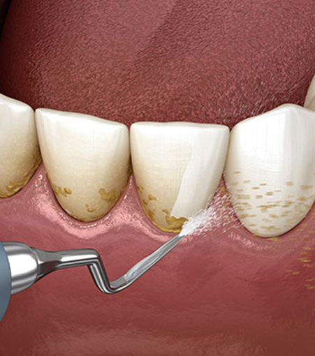 Ultrasonic Scaling Treatment