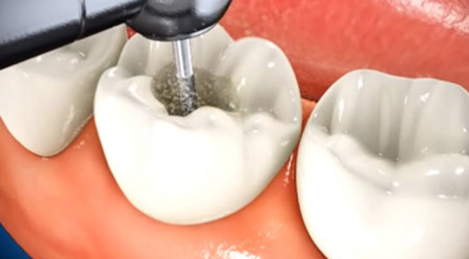 An Easy Guide to Painless Root Canal Treatment